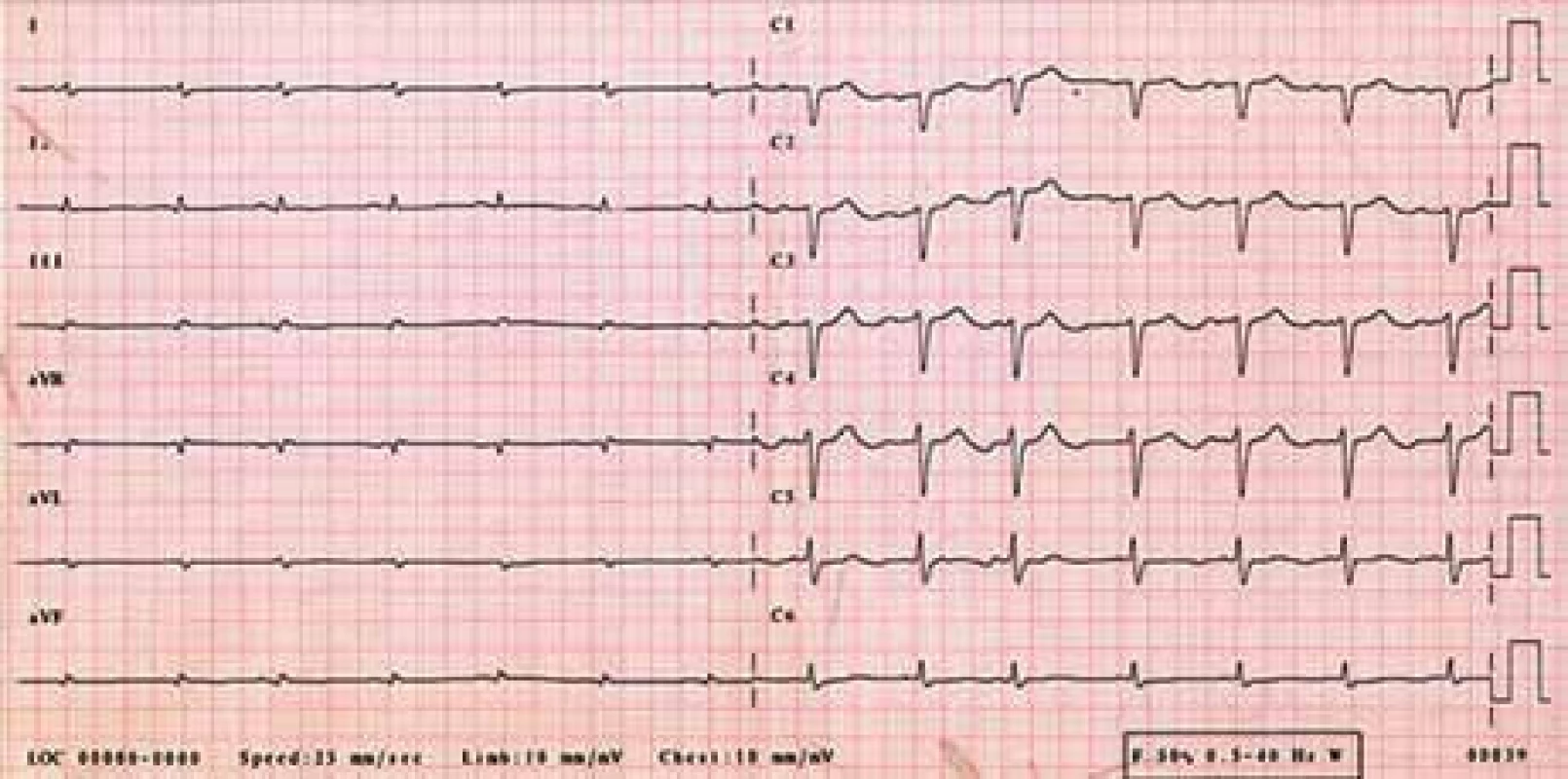 EKG – sinusový rytmus, výrazně nízká voltáž v končetinových svodech, obraz „pseudoinfarktu“ přední stěny (QS V<sub>1–3</sub>).