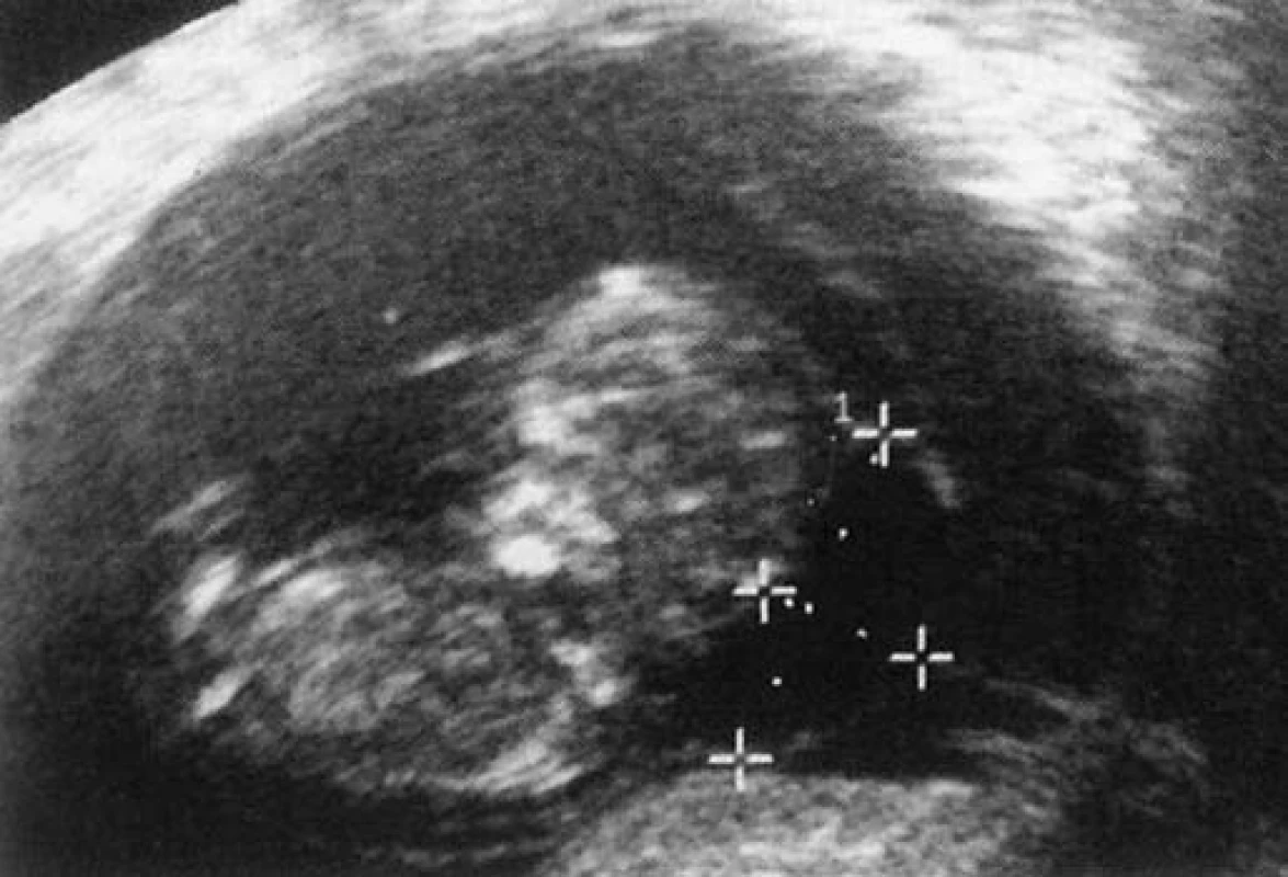 Hygroma colli cysticum (archiv autorů).
Fig. 1. Cystic hygroma colli cysticum (authors’ archive).