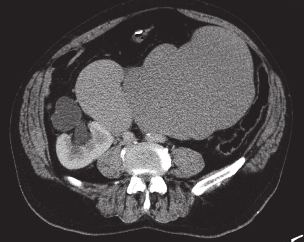 Expanze retroperitonea, transverzální snímek
Fig. 1. Expansion of retroperitoneum, tranversal slide