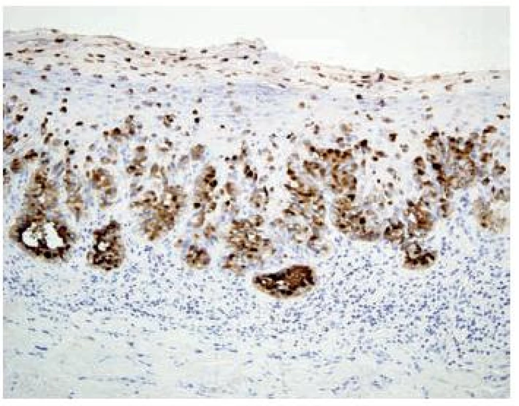 Imunohistochemicky jsou buňky EMA (epiteliální membranózní antigen) pozitivní (HE, x200)