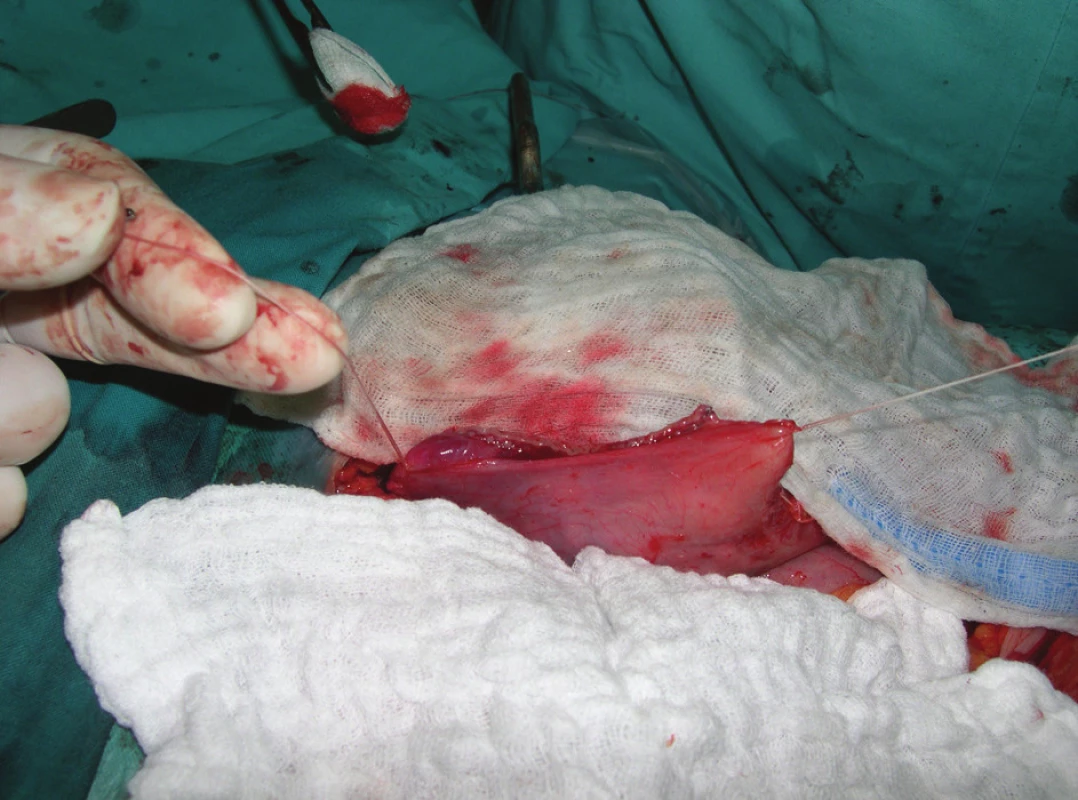 Stav po staplerovej resekcii divertikula
Fig. 4: View after the stapler resection of the diverticulum
