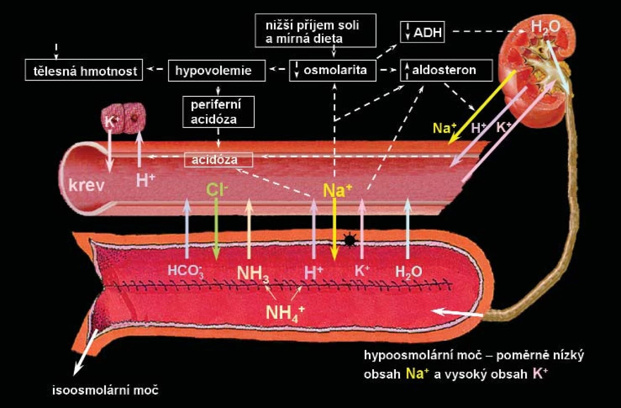 Mechanismus vzniku hyperchloremické acidózy (syndrom úbytku soli) u pacientů s ortotopickou neovezikou z ileálního segmentu. Následkem hypoosmolarické moči, kdy dochází ve střevě díky transportu NaCl do moči k obnově isoosmolárního stavu, se dostává úbytek soli výměnou za Na<sup>+</sup> a H<sup>+</sup> z moči do krevního řečiště.
Otištěno se svolením.
ADH – antidiuretický hormon, H<sub>2</sub>0 – voda, Na<sup>+</sup>– sodík, H<sup>+</sup>– vodík, K<sup>+</sup>– draslík, Cl<sup>-</sup> – chlor, HCO<sub>3</sub><sup>-</sup> – hydrogenuhličitan sodný, NH3<sup>-</sup> amoniak, NH4<sup>+</sup>– amonium [34].