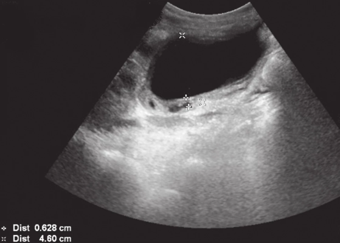 Šířka žlučníku 4,5 cm, stěna žlučníku se zesílením na 4−5 mm se stratifikací
Fig. 1: Gallbladder width 4.5 cm, wall thickening to 4−5 mm, stratified
