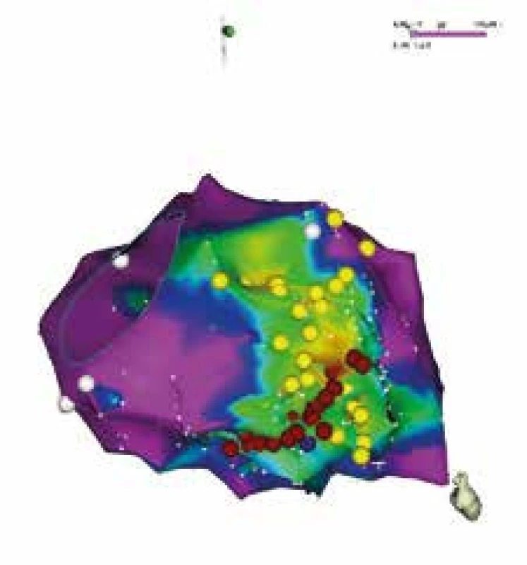 Voltážová elektroanatomická mapa levé komory u pacienta po ablaci fokálně spouštěné FiK časně po infarktu myokardu v pravé šikmé projekci