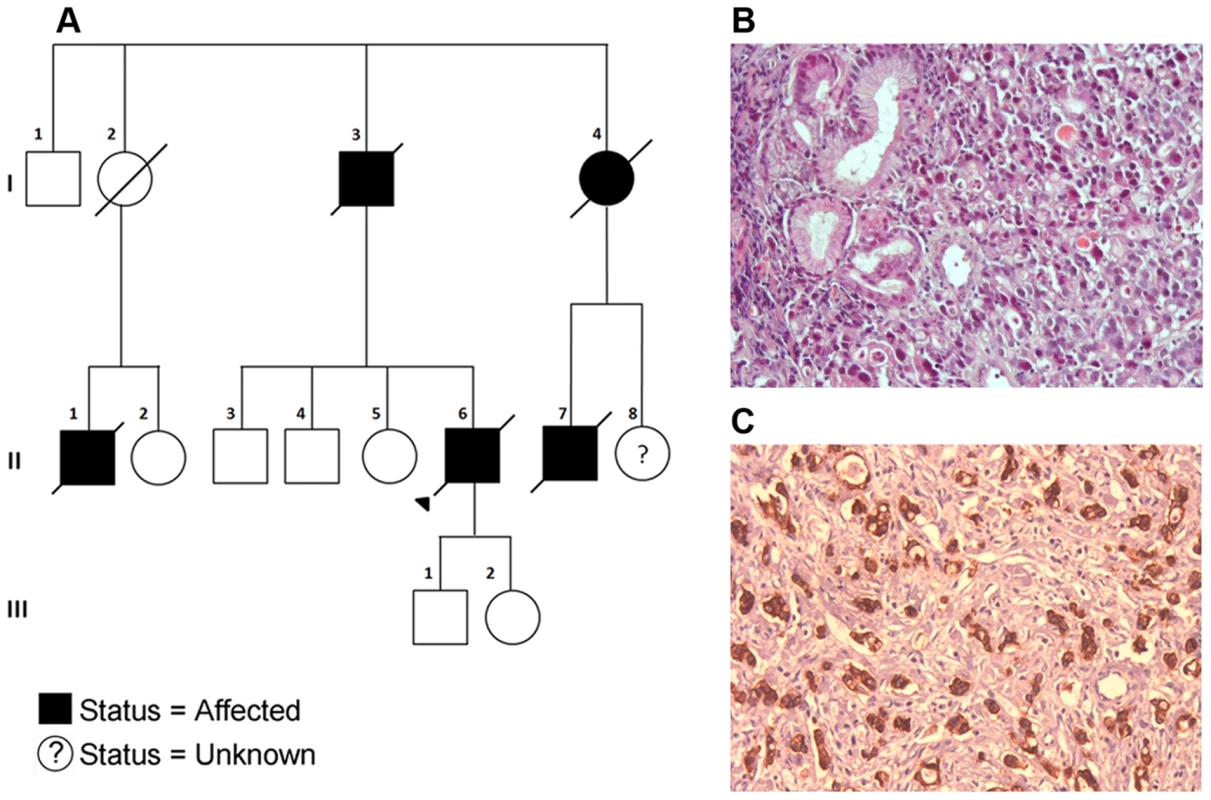 A) Pedigree of the Portuguese Familial Gastric Cancer family.