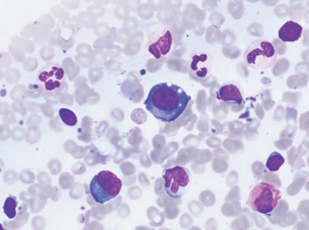 Cytologický obraz otisku válečku kostní dřeni. Jsou zřetelné dva atypické plazmocyty.
