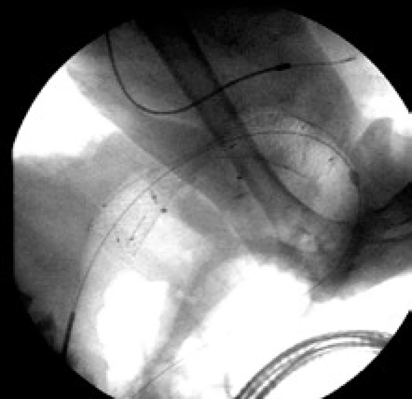Kolorektálny stent – Enterella (Ella-CS).
Fig. 1. Colorectal stent – Enterella (Ella-CS).