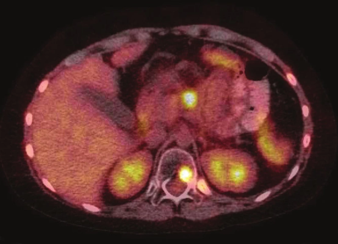 Celotelové PET/CT s <sup>18</sup>F-FDG. Ďalšia progresia ochorenia, mnohopočetné hypermetabolické dreňové aj osteolytické ložiská v skelete, progresia infiltrátu v prínosových dutinách, progresia malígnej lymfadenopatie krku a supraklavikulárne vľavo, nové infiltrované LU v dutine brušnej. [27.05.2014]