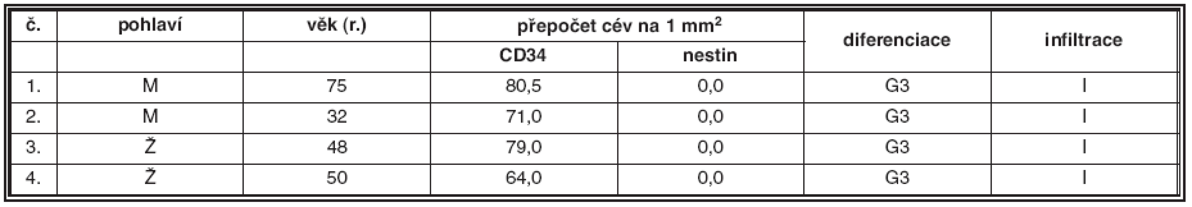 Plazmocytární myelom G3, intersticiální infiltrace