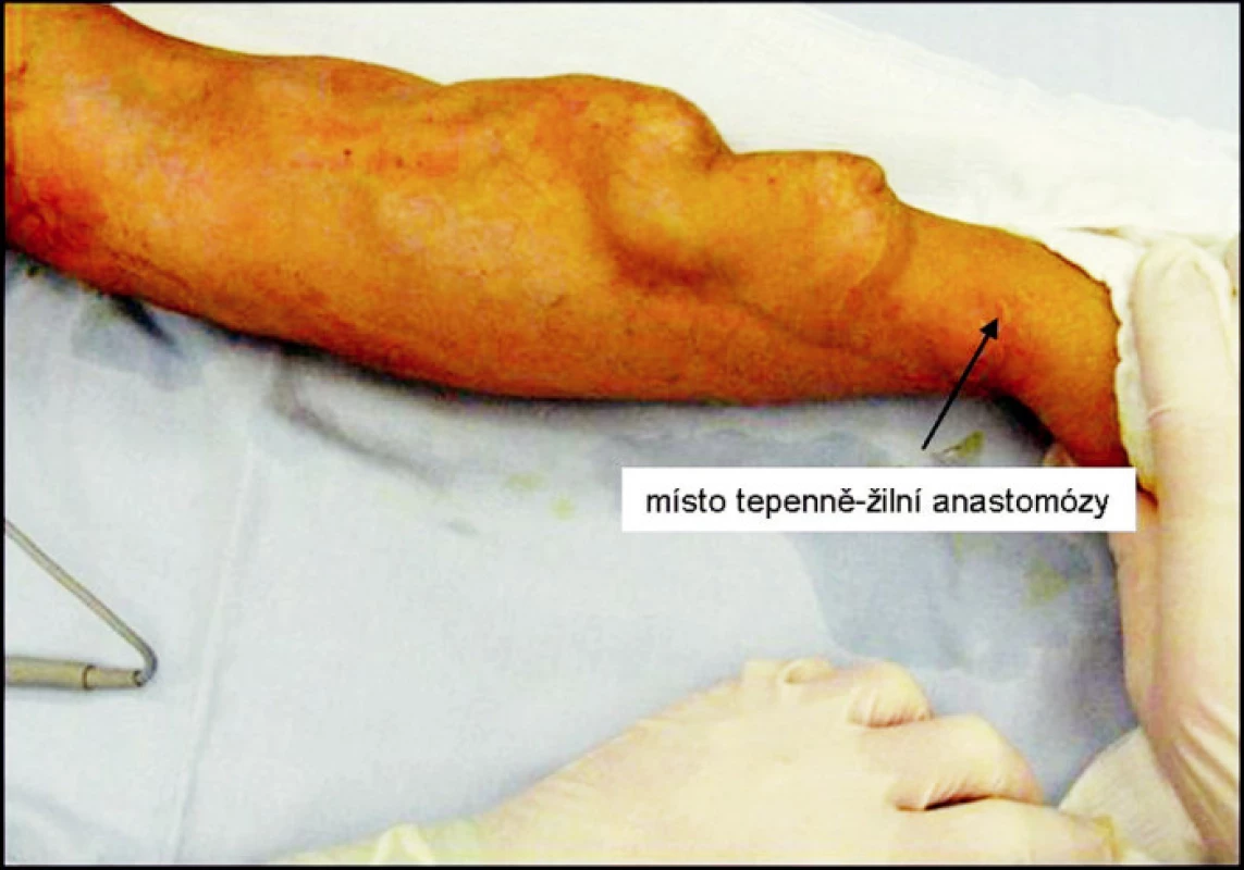 Pseudoaneuryzma radiocefalické píštěle 9 let od založení, šipka znázorňuje místo anastomózy
Fig. 5. A pseudoaneurysm of a radiocephalic fistule 9 years following its completion, the anastomosis is marked by an arrow