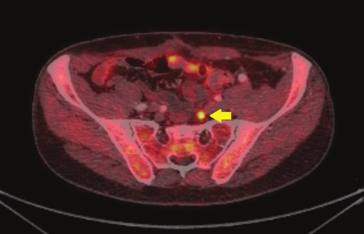 18F-cholin-PET/CT: transaxiální fúze PET/CT obrazu zobrazující vyšší aktivitu radiofarmaka v ilické lymfatické uzlině (žlutá šipka)
Fig. 1: 18 F-choline PET/CT: transaxial PET/CT fusion image demonstrating focal tracer uptake in iliac node (yellow arrow)