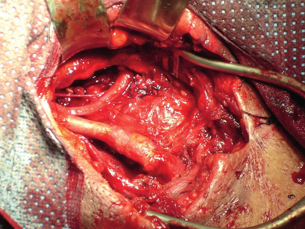 Rekonstrukce ACI E-E s ACC
Fig. 7: Reconstruction of ICA E-E with ACC
