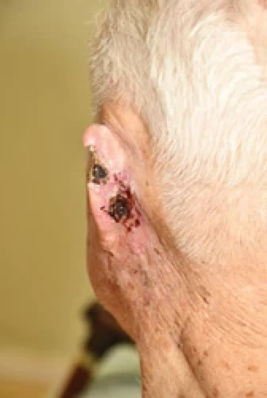 Adnexal adenocarcinoma of the left ear and back of the ear.