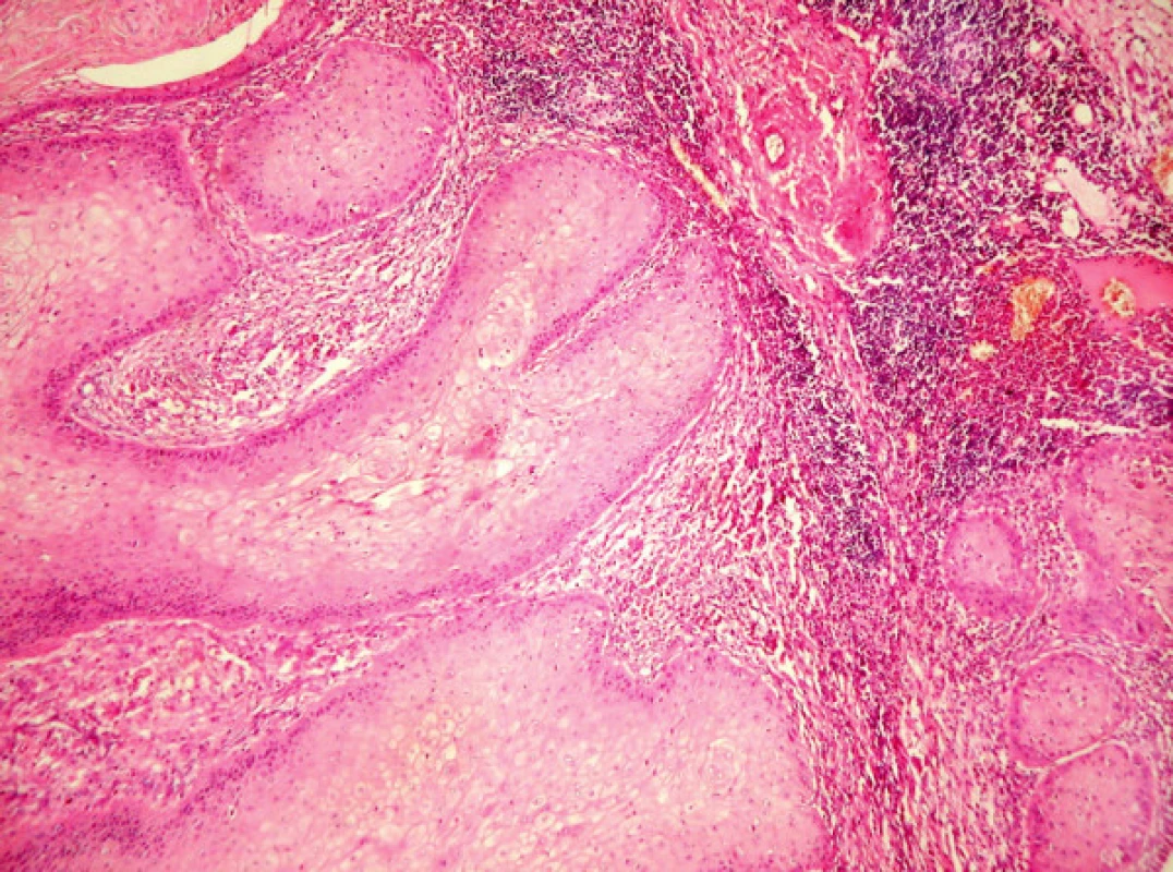 Mikrofotografia metastázy SCC v inguinálnej lymfatickej uzline (hematoxilín-eozín, 100x).
Fig. 3. A microphotograph of the SCC metastasis in the inguinal lymphnode (hematoxyllin-eosine staining, 100x).
