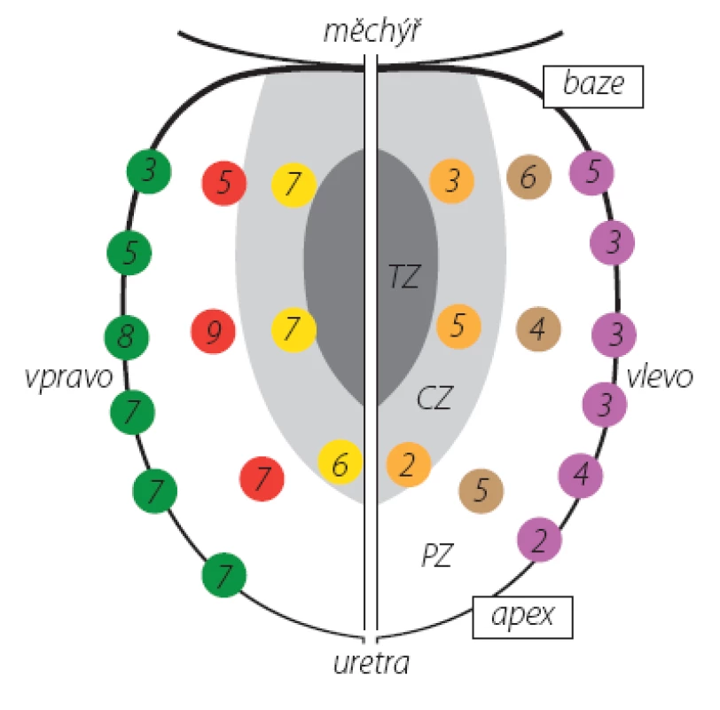 Počet pozitivních vzorků v lokalizacích biopsie u 34 pacientů (celkem 123 vzorků)
TZ – tranzitorní zóna, CZ – centrální zóna, PZ – periferní zóna
Fig. 2. Number of positive cores in biopsy localizations in 34 patients (a total of 123 cores)
TZ – transition zone, CZ – central zone, PZ – peripheral zone