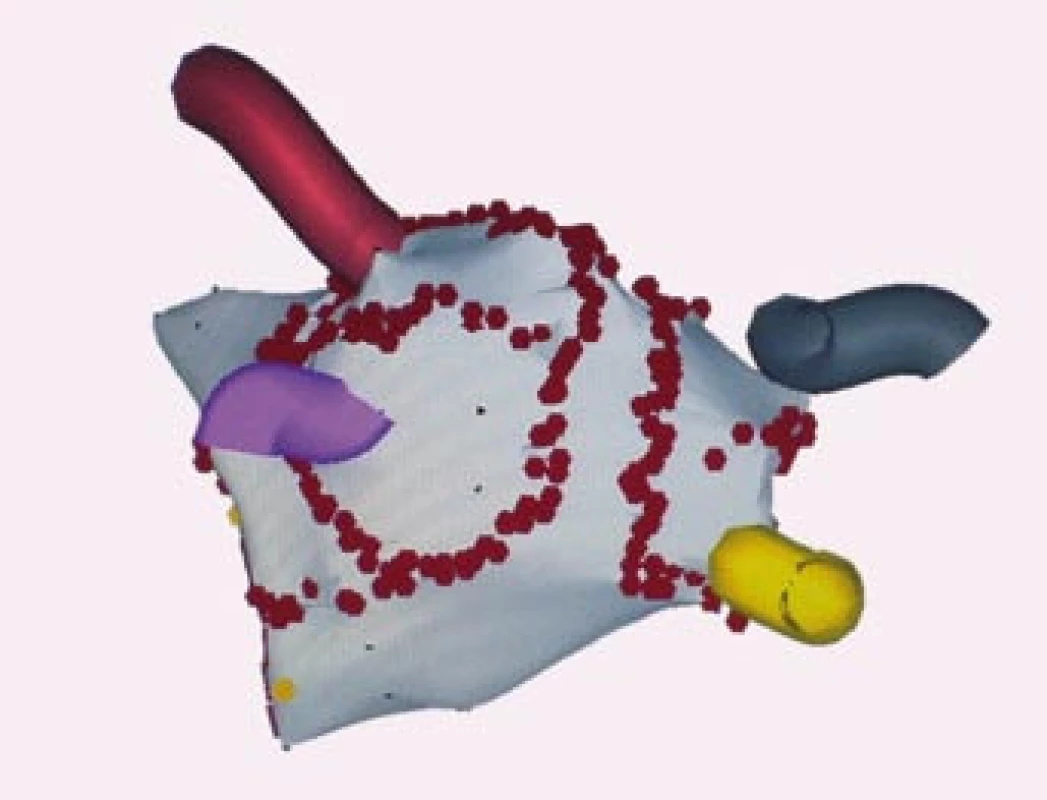Trojrozměrné elektro anatomické mapování systémem CARTO, projekce PA‑posteroanteriorní.