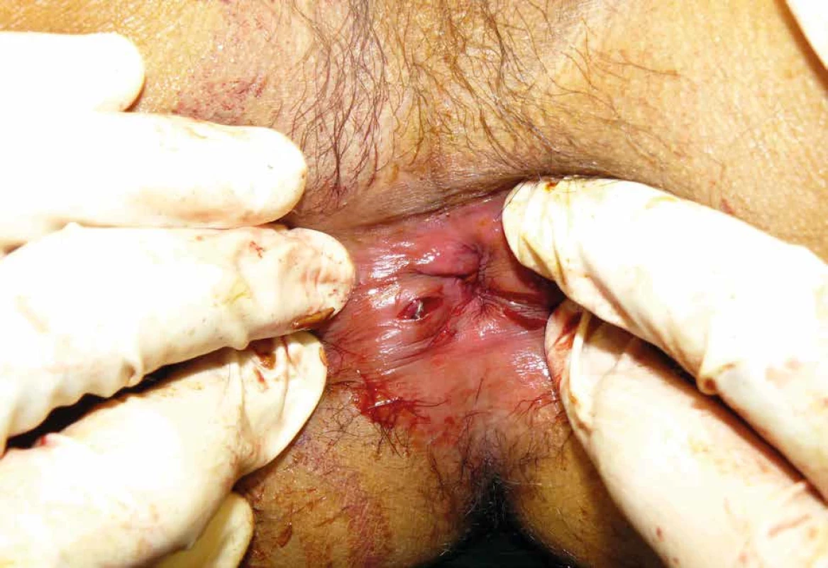 Penetrující střepinové poranění anorekta   Fig. 6: Penetrating shrapnel injury of the anorectum