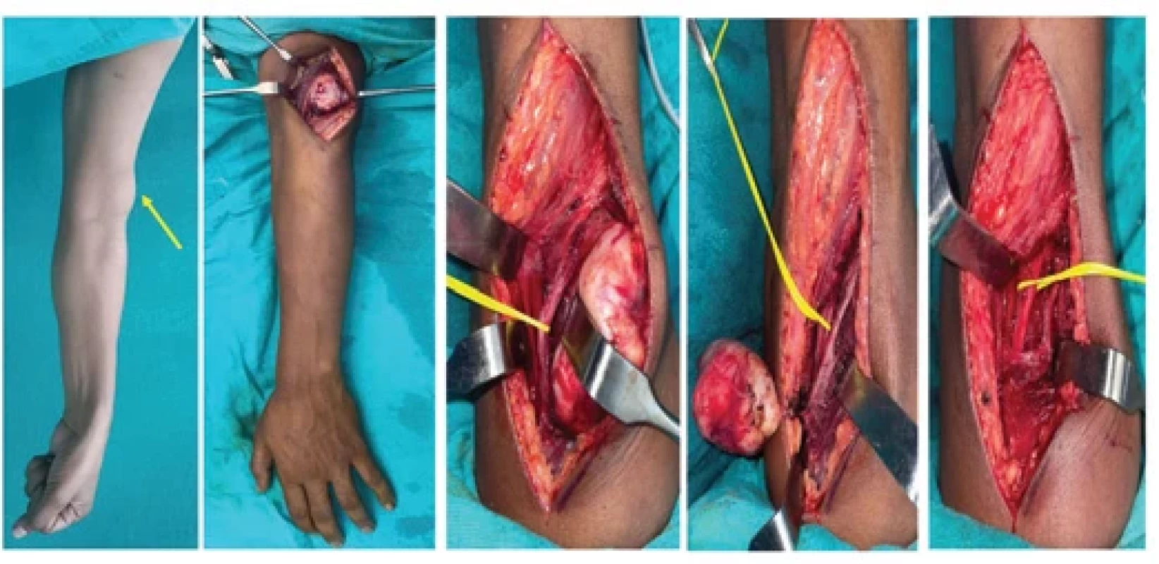 Schwannoma arising from the left side main radial nerve; on exploration, it was found to originate from a single fascicle. The tumor was excised preserving the nerve fascicle.
