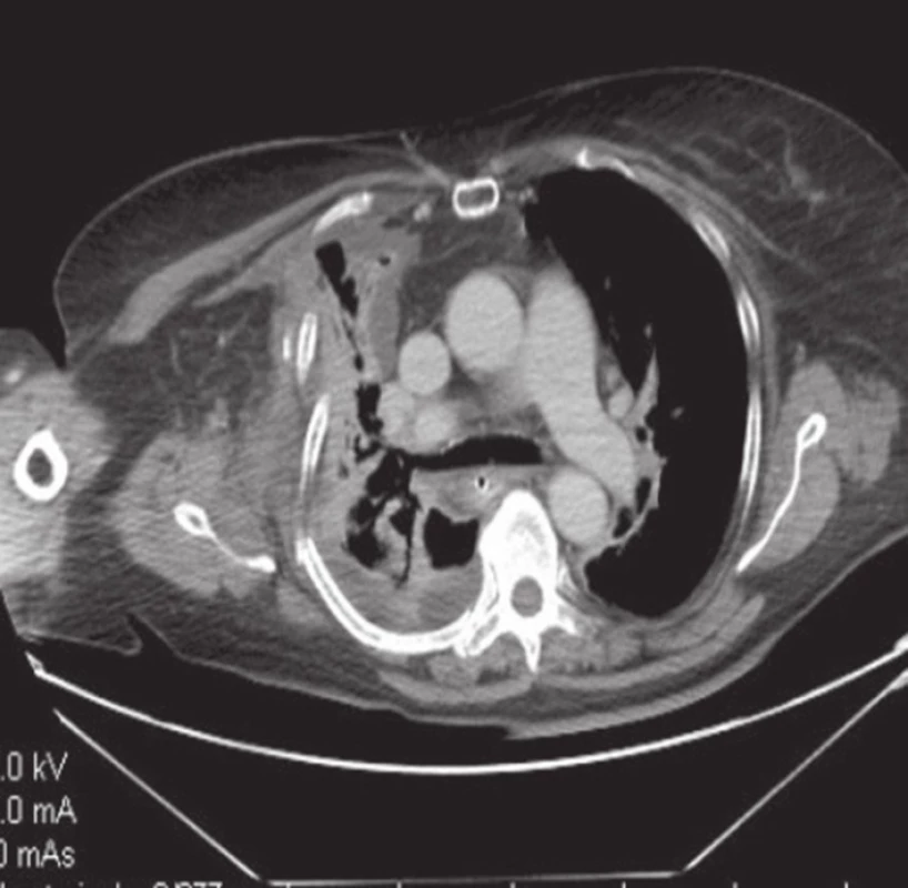 Kolaps hrudní stěny
Fig. 1: Chest wall collapse