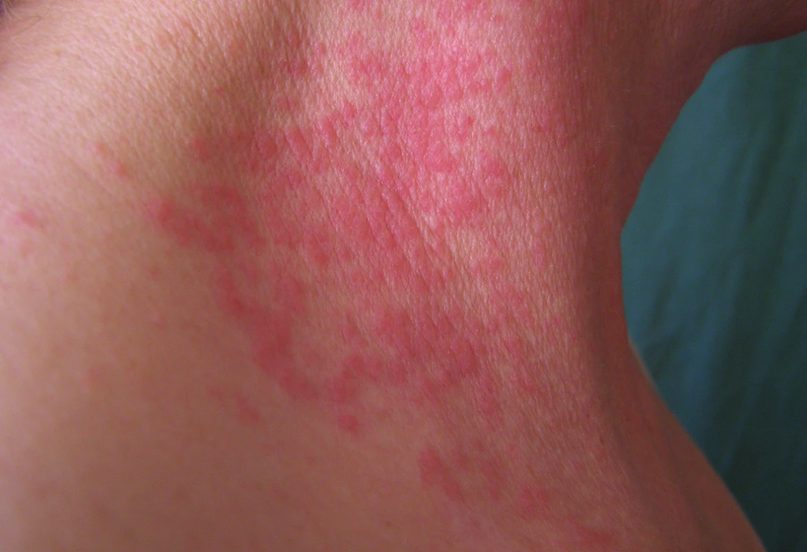 Airborne alergická kontaktní dermatitida po kalafuně