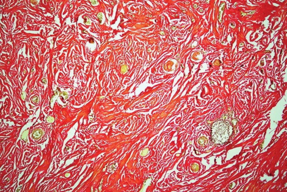 Characteristic appearance of CFT - hyalinized hypocellular fibrous lesion with variably prominent lymphoplasmacytic infiltration and calcifications (van Giesonʼs stain, 100x).