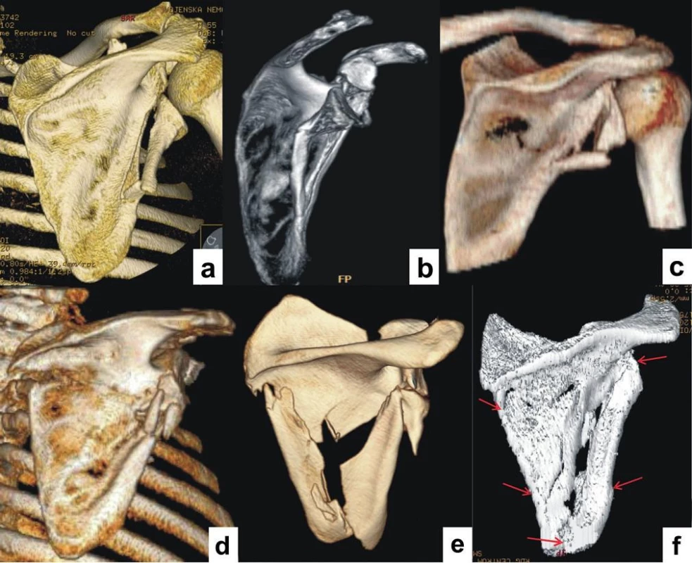 Různé typy zlomenin dolního glenoidu: a+b – izolované zlomeniny dolního glenoidu; c+d+e+f+g – zlomeniny dolního glenoidu spojené se zlomeninou biomechanického (infraspinátní části) těla.
Fig. 9: Different types of fractures of inferior glenoid: a+b – isolated fractures of inferior glenoid; c+d+e+f+g – fractures of inferior glenoid associated with fractures of biomechanical (infraspinous part) scapular body.