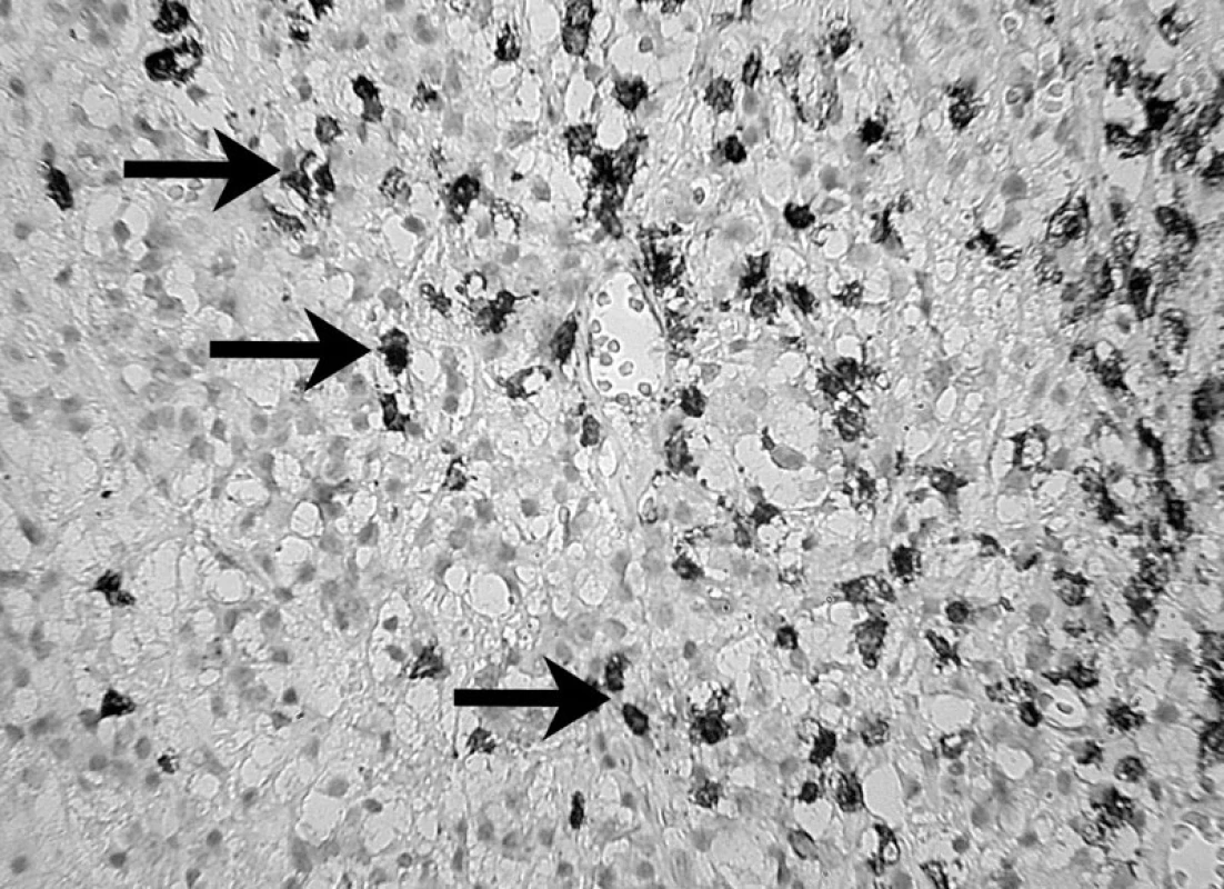 Prítomnosť B – lymfocytov v periapikálnom granulóme a ich identifikácia pomocou protilátky L-26 (DAKO) – autor Ján Kováč
Fig. 6. The presence of B lymphocytes in periapical granuloma and their identification using the L-26 antibody (DAKO) – Author Ján Kováč.