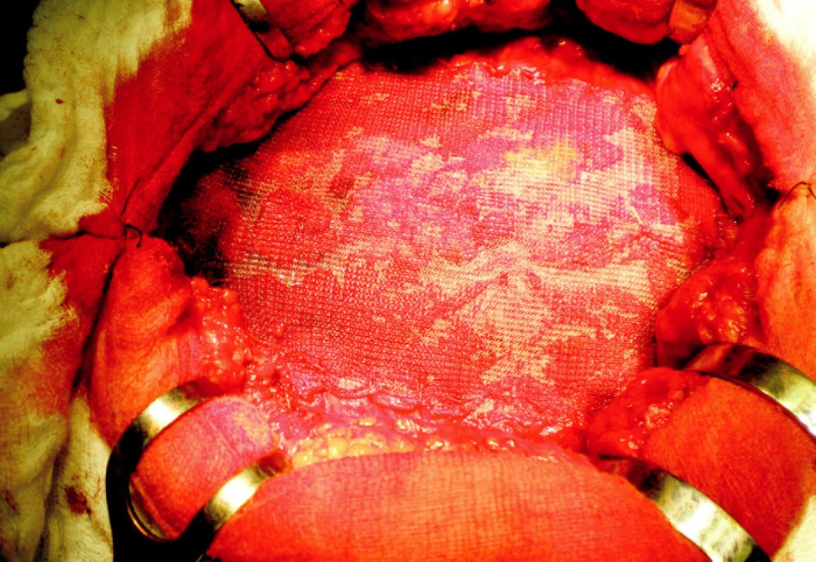 Stav po zresekovaní vaku hernie, relaxačných incíziách, zošitiu mediálnych okrajov a onlay fixovaní sieťky
Fig. 6. The resected hernial sac, completed relaxing incisions, suturing of the medial edges and on- lay mesh fixation
