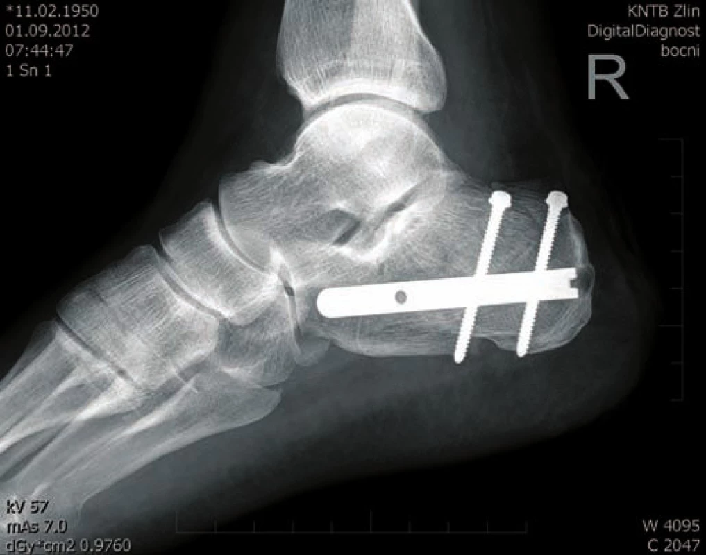 Osteosyntéza hřebem C nail Medin - laterální projekce