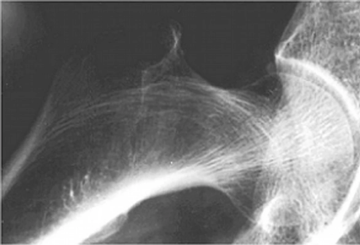 Osteoporosis senilis