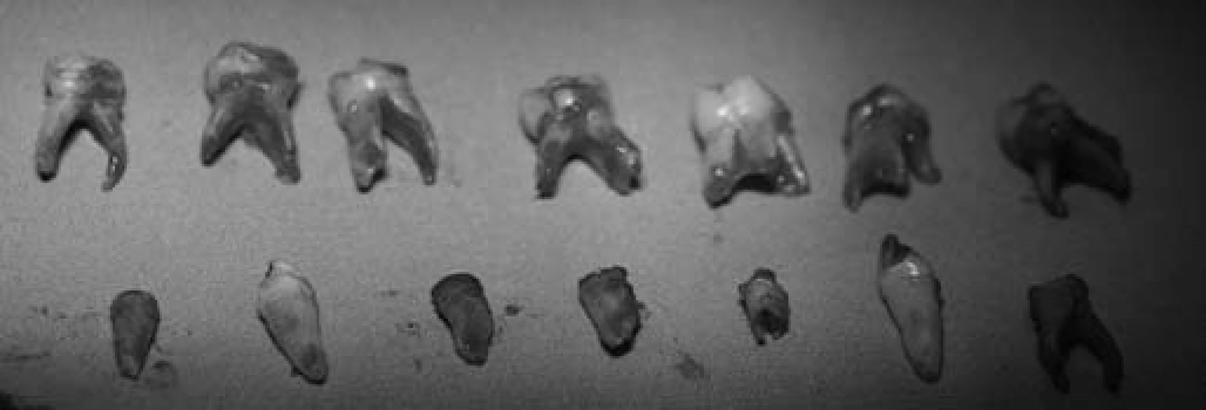 Stav po radikálním ošetření dočasného chrupu – extrahované zuby.
Fig. 5. Status after the radical treatment the temporary teeth – extract teeth