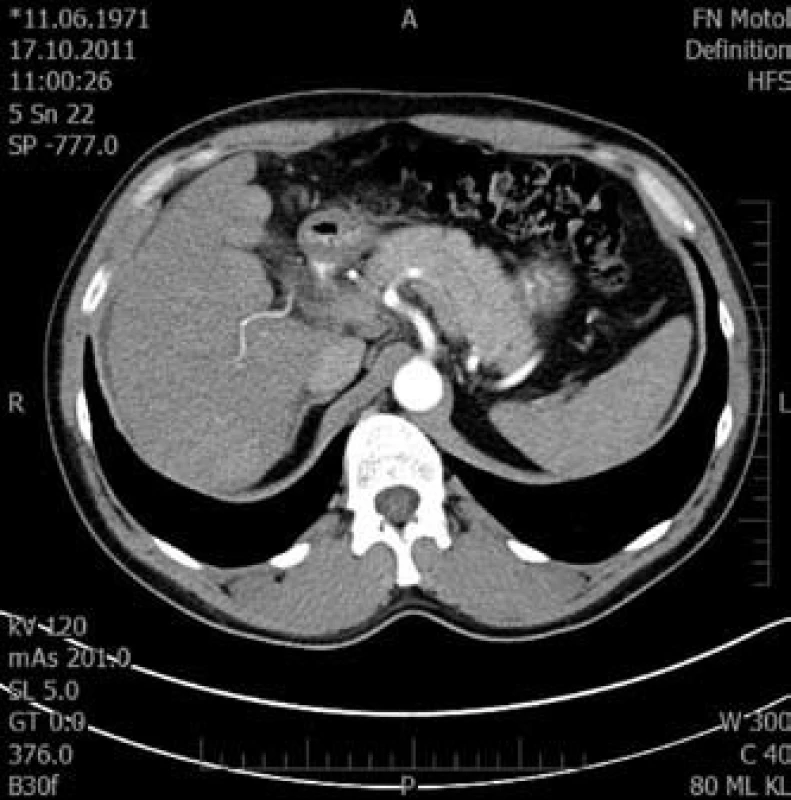 Tranzverzální řez pravého laloku jaterního v arteriální fázi.
Fig. 4. Transversal cut of right liver lobe in arterial phase.