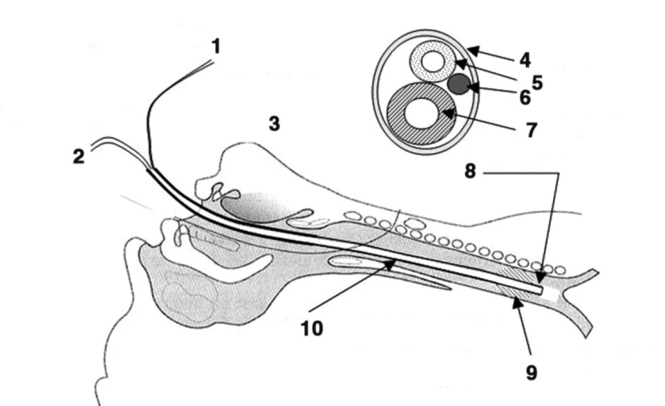 Schematické znázornenie zavedenia insuflačného katétra pre K-VFDV
1 – Ventilátor vysokofrekvenčný
2 – Pin (insuflačný tlak – pohonný)
3 – Pt (tracheálny tlak – meraný)
4 – Obal
5 – Merací katéter
6 – Kovová výztuha – stabilizátor
7 – Insuflačný katéter
8 – Rez katétrom
9 – Bez akéhokoľvek tesnenia balónom (manžetou) = nehermetický systém ventilácie