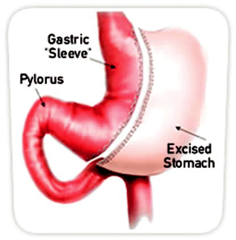 Sleeve gastrektomie