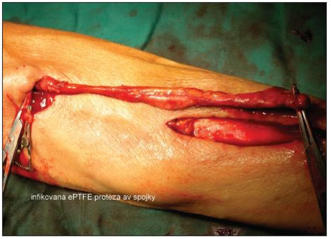 Infikovaná ePTFE protéza av spojky
Fig. 2. Infected ePTFE A-V shunt prosthesis
