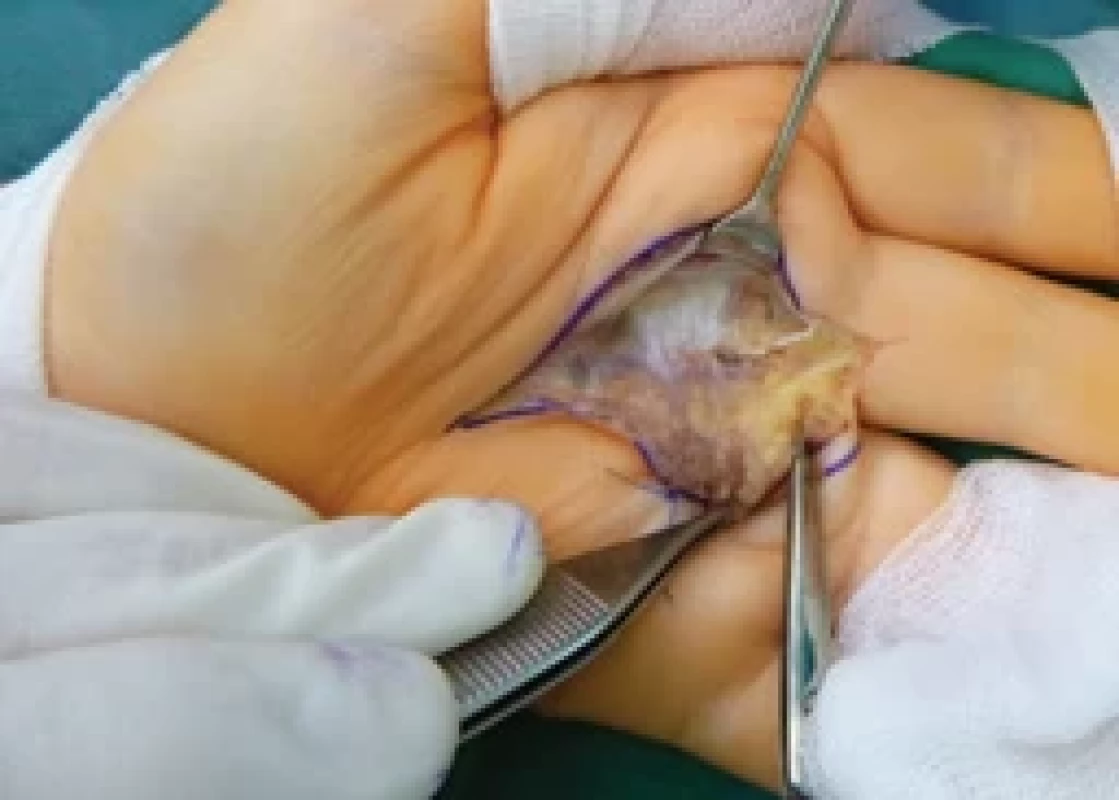 The metacarpophalangeal joint volar plate entirely dissolved, not suitable for reconstruction.