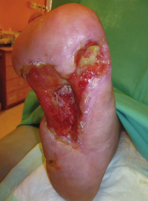 Lokální nález po 5 měsících terapie
Fig. 8: Local finding after 5 months of therapy