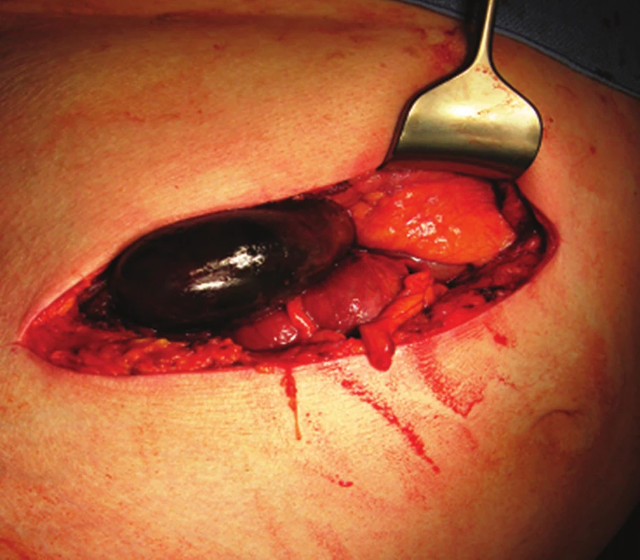 Gangrenózní žlučník po otevření dutiny břišní
Fig. 4: Gangrenous gallbladder after opening the abdominal cavity