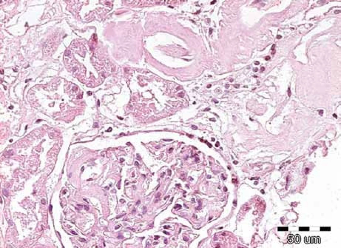Na obrázku jsou patrná nepříliš nápadná depozita v glomerulu, ale výraznější eozinofilní homogenizace stěn arteriol se zúženými luminy. Přítomnost těchto depozit nutně vede k indikaci dalších speciálních vyšetření, která potvrzují či vylučují přítomnost amyloidových hmot. Barvení hematoxylin-eozinem, původní zvětšení 200krát.