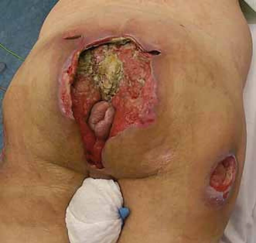 Rozsáhlý sakrogluteální dekubitus.
Fig. 7. Extensive sacrogluteral decubitus (pressure ulcer).