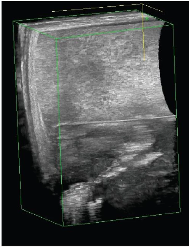 3D endosonografický obraz typické transsfinkterické píštěle
Fig. 1: 3D endosonography imaging of typical transsphincteric fistula