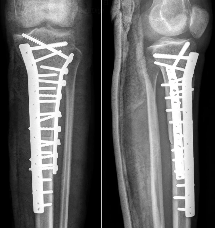 Náhrada proximální tibie s využitím osteochondrálního aloštěpu