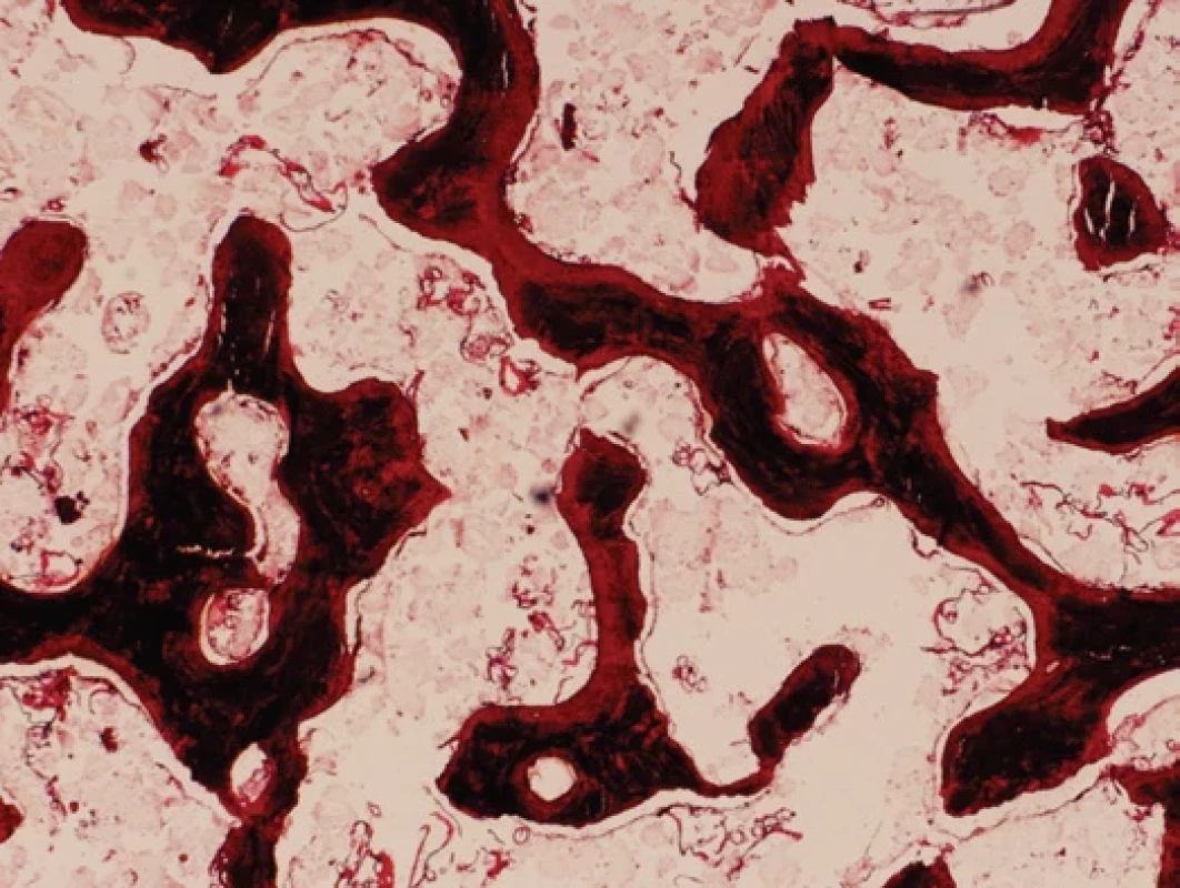 Histologický obraz vzorku z pánevní kosti zpracovaného metodou neodvápněných řezů, která umožnila po stříbření odlišit mineralizovanou (černě) a nemineralizovanou složku (osteoid) v kostní tkáni. Demineralizovaná složka tvořila zhruba 30 % objemu kostních trámců. Její přítomnost jednoznačně doložila chorobu známou jako osteomalacie. U zdravých jedinců nemineralizovaná komponenta tvoří pouze 2 % objemu kostních trámců. Stříbření podle von Kossy.