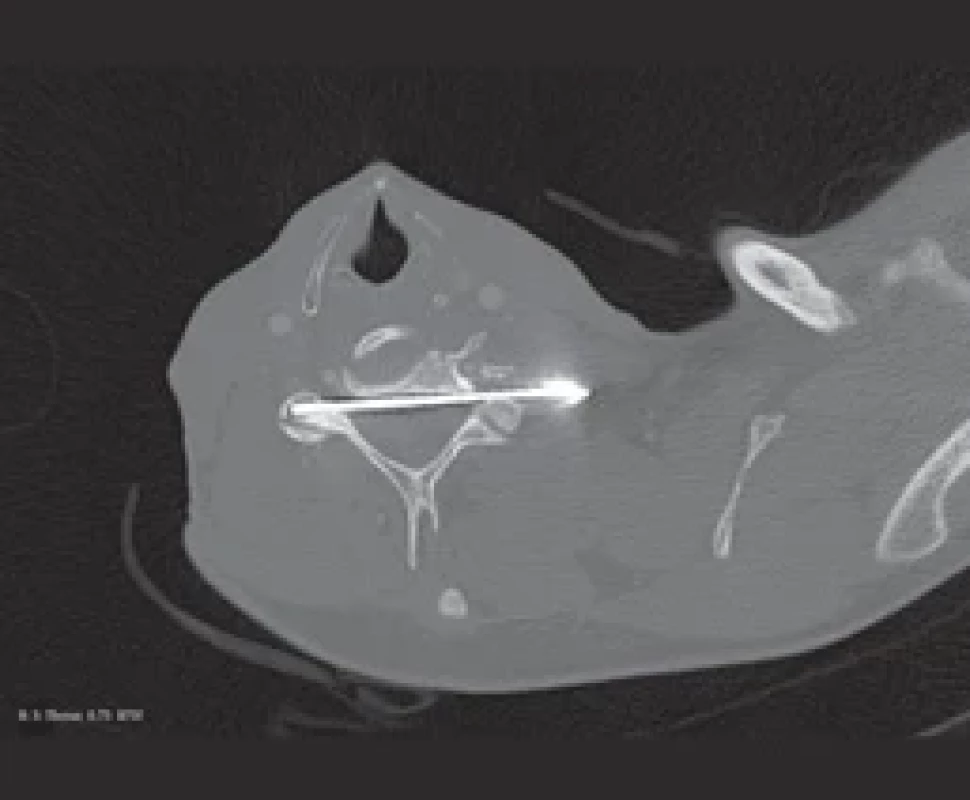 CT snímok pozície K-drôtu. </br>Fig. 2. CT scan of K-wire position.