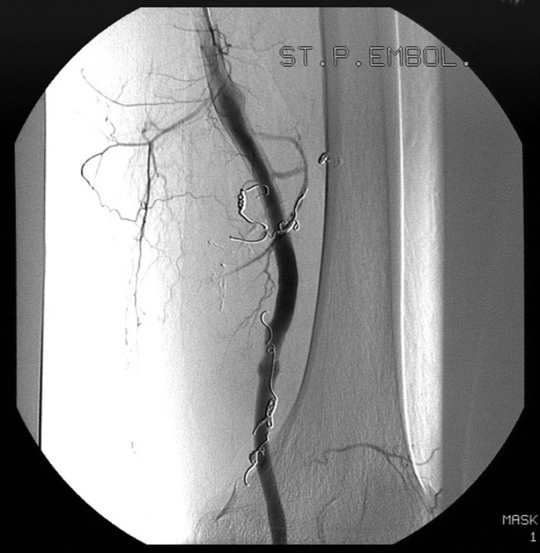 Digitální subtrakční angiografie levé dolní končetiny po embolizaci 5 větví arteria femoralis superficialis, které zásobovaly popliteální aneuryzma.
Pic. 9. Digital subtraction angiography of left lower extremity after embolisation of five branches of superficial femoral artery that fed popliteal aneurysm.