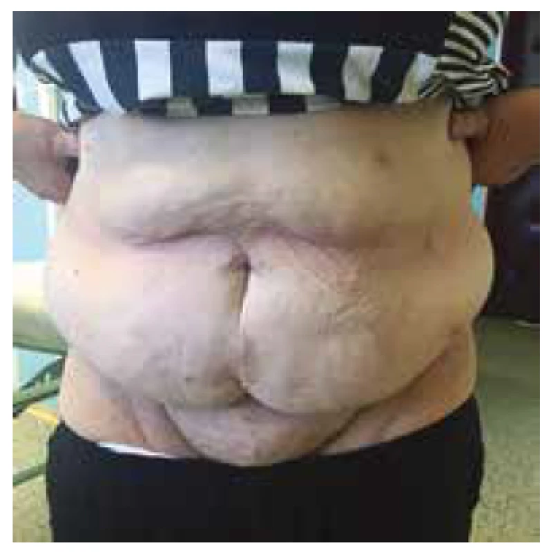 Pacientka 1 rok po operaci<br>
Fig. 2: The patient one year after the surgery