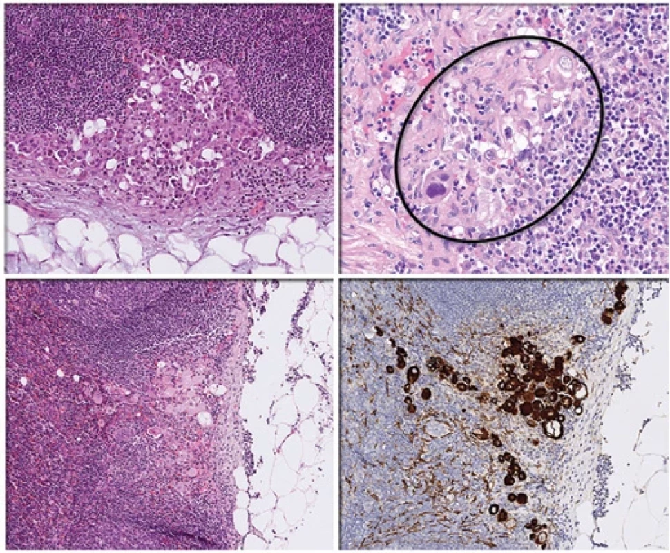SLNs with macro-metastases (A, C, D) and isolated tumor cells (B, encircled). Stained with conventional H&E (A–C) and pan-cytokeratin (D). Magnifi cation: (A) ×10, (B) ×40, (C) ×10, (D) ×10. Slides (С) and (D) made from one specimen.