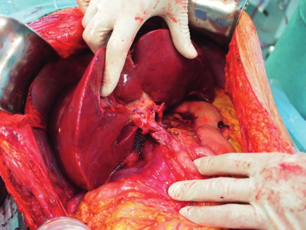 Transplantace jater - anastomóza porty štěpu a příjemce „end-to-end“.