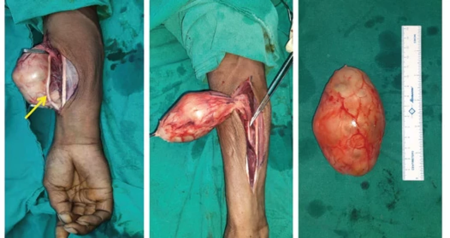 Schwannoma arising from the median nerve, the same removed with preservation of all nerve fascicles of median nerve.