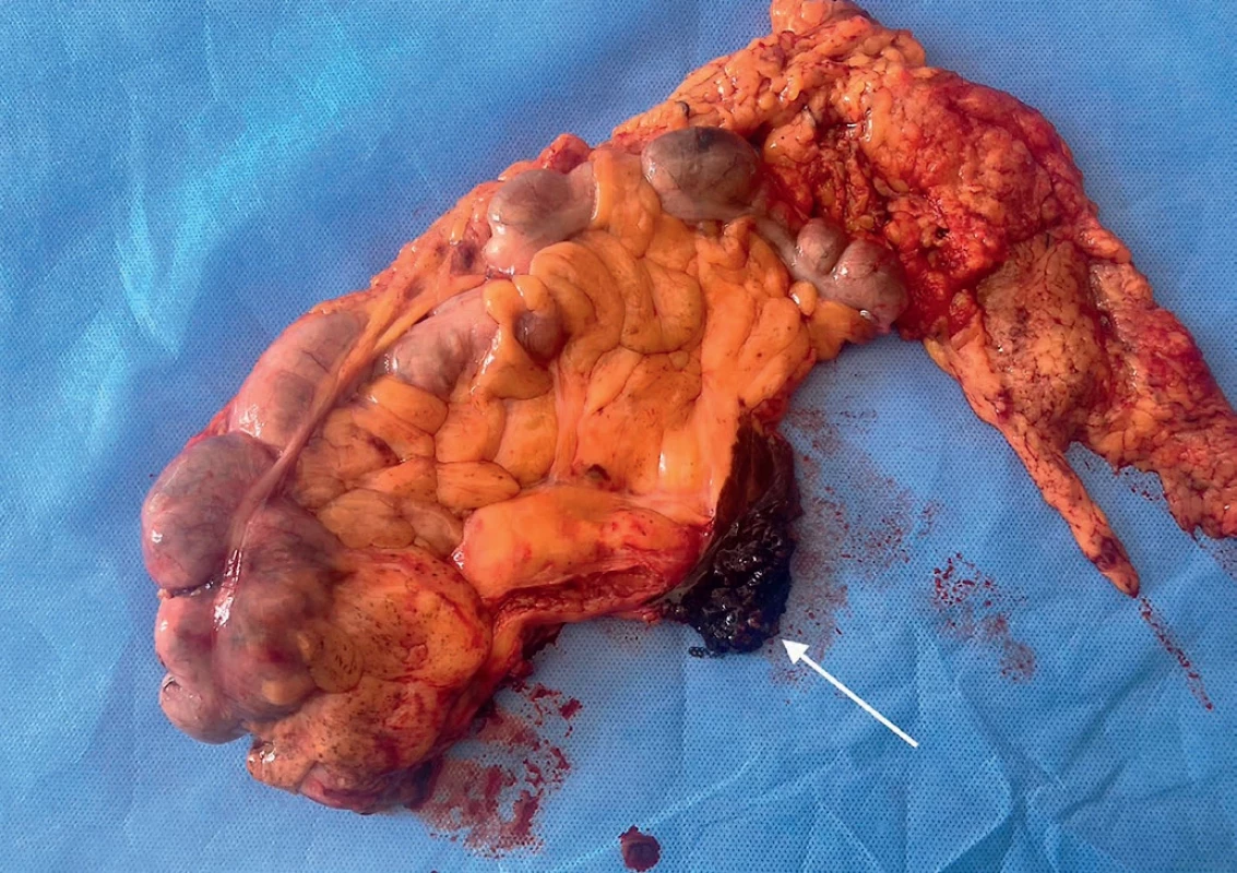 Right-sided hemicolectomy with complete mesocolic excision – D3 area of lymph nodes (white arrow) marked with ink.